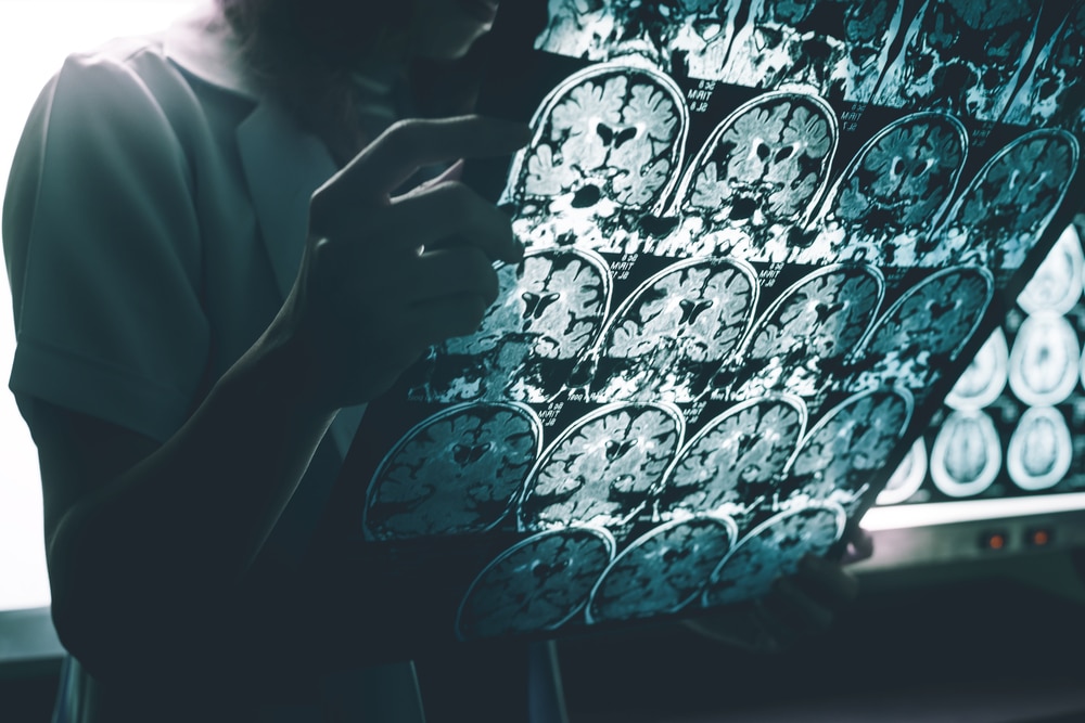 New study claims Alzheimer's can spread between humans