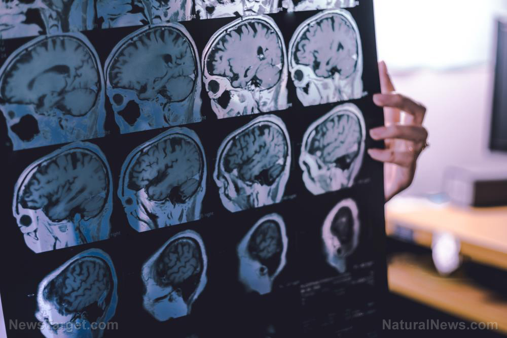 Steve Kirsch: CDC FORGOT to warn the public that COVID-19 vaccines cause DEMENTIA   – NaturalNews.com