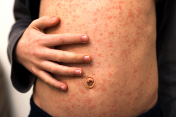 Ohio Department of Health: People who recently traveled through northern Kentucky airport may have been exposed to measles   – NaturalNews.com