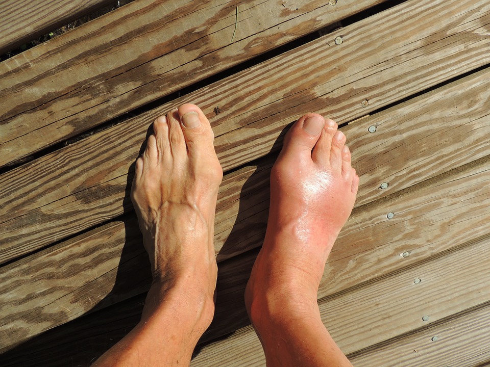 Get natural relief from gout with these 10 home remedies   – NaturalNews.com