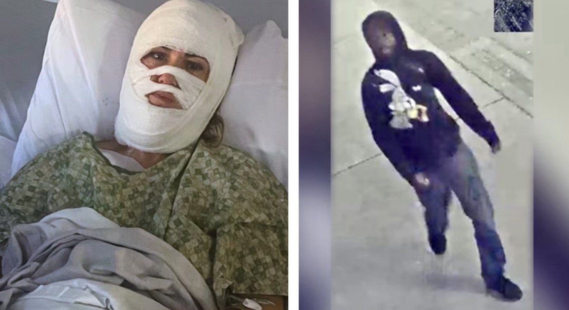 HORROR: Georgia Woman Suffers Severe Burns to Her Face, Neck and Scalp After Stranger Douses Her with Acid at Park - Suspect at Large | The Gateway Pundit | by Cristina Laila