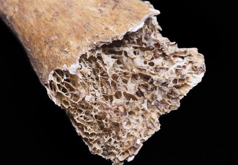 GLP-1 drugs linked to accelerated bone loss, osteoporosis risk in new five-year analysis   – NaturalNews.com