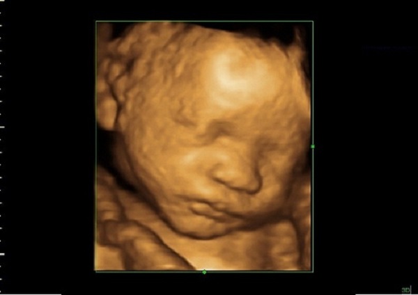 No a Judge Did Not Rule Abortion Pills are Safe - LifeNews.com