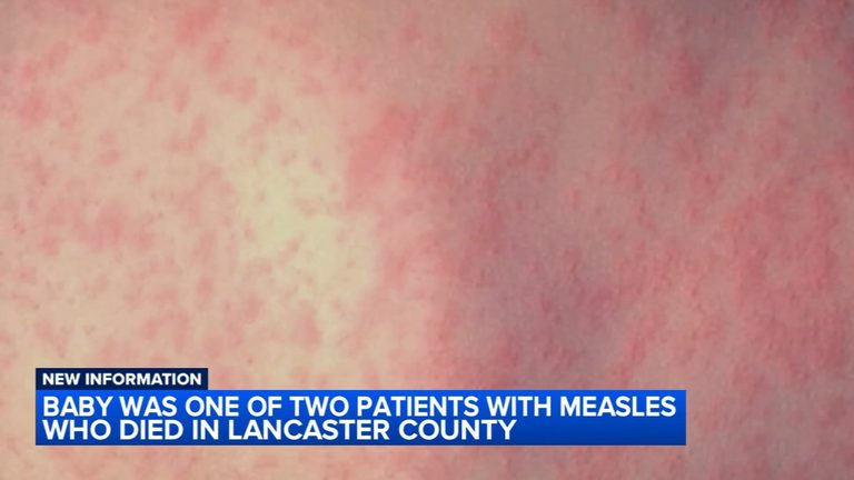 Infant and Adult Die of Measles in Lancaster County Amid Rising Cases