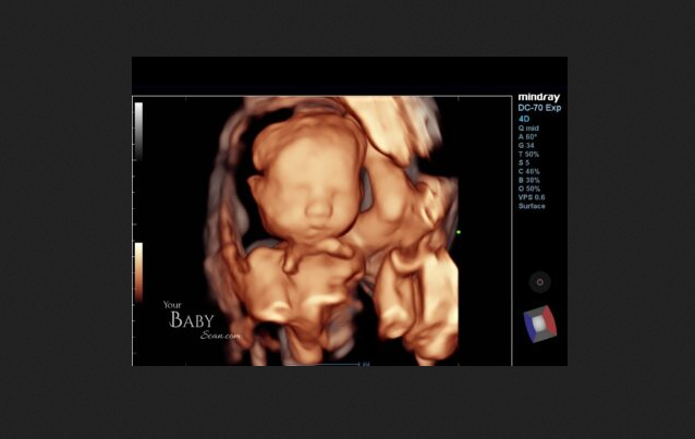 Abortions Could Surge in States With Abortions Up to Birth - LifeNews.com