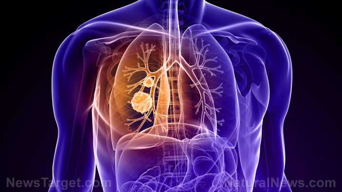 Microplastics found in lungs linked to lung cancer, new research shows   – NaturalNews.com